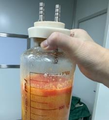 福州水动力吸脂手术要做多久？